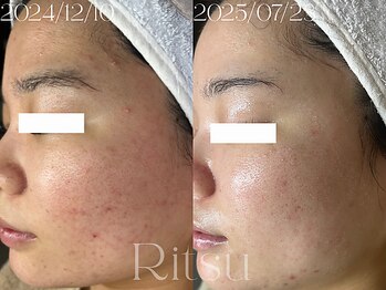 リツ(Ritsu)/ニキビケア/赤み/毛穴/美白