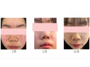 ココユール(cocoyull)/ハーブテントのビフォーアフター