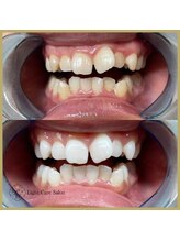 ライトケアサロン 銀座店(Light Care Salon)/セルフホワイトニングの症例写真