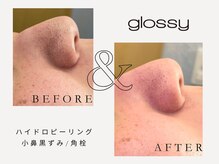 グロッシー(glossy)/【症例】小鼻皮脂詰まり黒ずみ
