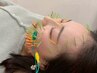 【人気No.1】百華鍼（ひゃっかしん）100本の美容鍼＋小顔矯正＋猫背矯正¥9500