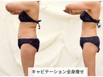 トレゾール(tresor)/【痩身】赤坂痩身エステtresor