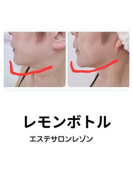 レゾン 京橋店/[レモンボトル]ビフォーアフター
