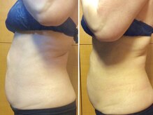 ピュアリー(purly)/【レモンボトル】Before After