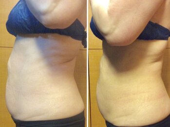 ピュアリー(purly)/【レモンボトル】Before After