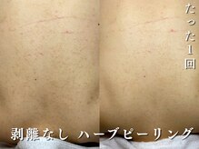 ダリア(Dahlia)/剥離なし背中ハーブピーリング