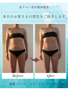 アロハ美容整体院 花巻店/肩こり改善★リリースカッター
