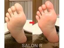 サロンアール(SALON R)/3ヶ月で冷え改善 35℃台→36℃台