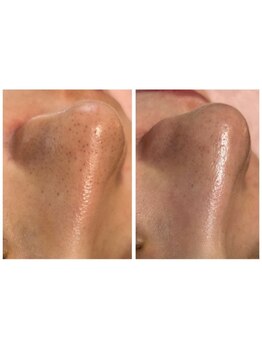 毛穴ケアをしたい