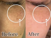 いやしの家さくら/シミケアのビフォーアフター