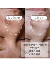 ゼニス 池袋本店(ZENITH)/しつこい黒ずみをララピールで♪