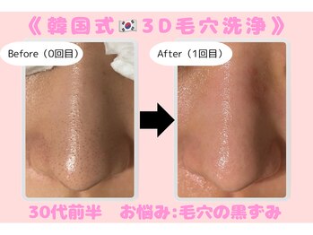 ウル 下北沢(Ulu)/韓国式３D毛穴洗浄