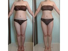 整骨院 壱/セルキャビプラス（脂肪分解）