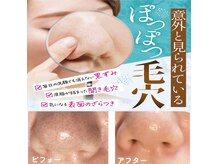 長年毛穴の汚れ悩みなら月1回～2回施術で3～4ヶ月で解決できる！