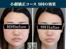 キュープ 表参道店(Qpu)/継続が「小顔」と「美」をつくる