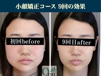 キュープ 表参道店(Qpu)/継続が「小顔」と「美」をつくる