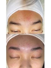 シェーン(schon)/初めてのブロウリフト