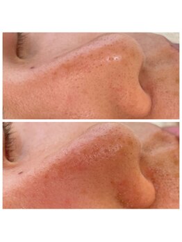 グレイス(Grace)/毛穴詰まり吸引