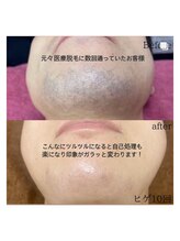 エモーションプラス(Emotion plus)/八王子ヒゲ脱毛　before・after