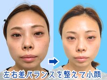 ナチュラルパーフェクトフェイス 新宿/顔の左右差改善/新宿小顔/渋谷区