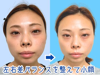 ナチュラルパーフェクトフェイス 新宿/顔の左右差改善/新宿小顔/渋谷区