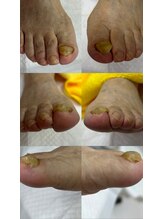 ドクターネイル爪革命 十条店/肥厚爪ケア