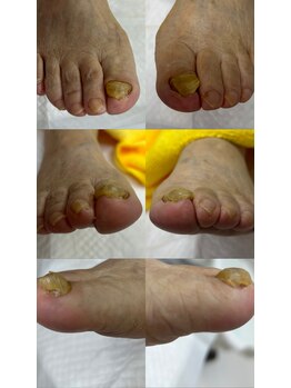 肥厚爪ケア