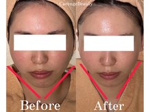 カレンジェビューティー(CarengeBeauty)/四日市エステ/小顔