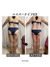 リヘッド(Re.head)/ハイパーナイフ　頑固な脂肪撃退
