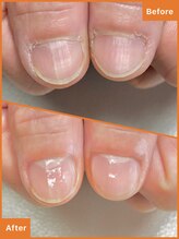 ワイ(Y)/べったり甘皮