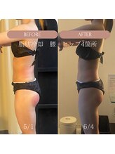 美容痩身ラボ 松山院/施術経過