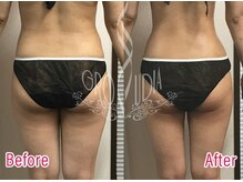 グラウディア 恵比寿/痩身/筋膜リリース/インディバ超