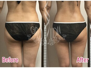 グラウディア 恵比寿/痩身/筋膜リリース/インディバ超