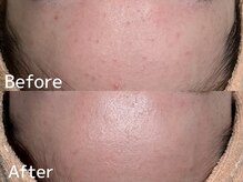 カレンジェビューティー(CarengeBeauty)/プラチナクレイピール