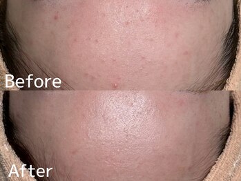 カレンジェビューティー(CarengeBeauty)/プラチナクレイピール