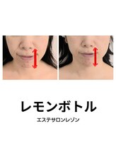 レゾン 京橋店/[レモンボトル]ビフォーアフター