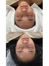 フラウラ(Fraula)/ハーブピーリング