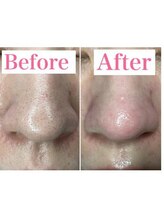 トータルビューティーサロン 凛/毛穴エステ