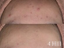 ホワイトアクア 梅田本店(WHITE AQUA)/ハーブピーリング/毛穴/梅田