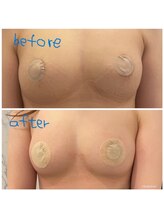 ルミエール(Lumiere)/【倉敷市】バストアップ施術事例