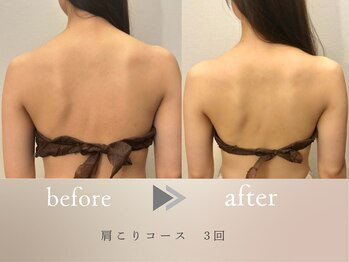 グロッシー(glossy)/機器を使用する肩こりコース