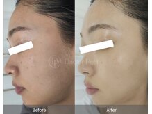 グレース 江坂(GRACE)の雰囲気(ララピールの進化版【ダクトピール】でうる艶肌を手に入れよう♪)