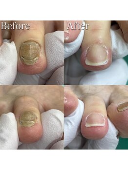 巻き爪補正店 越谷店/変形爪補正