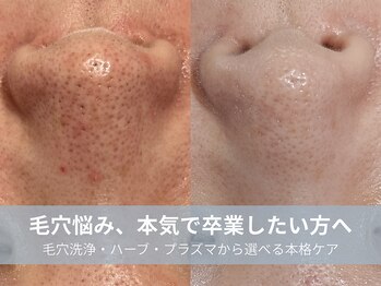 ラシック 加古川店(La chic.)の写真/加古川駅5分!毛穴洗浄・ハーブピーリング・プラズマシャワーで頑固な鼻の黒ずみ・開きを徹底ケア