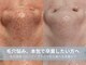ラシック 加古川店(La chic.)の写真/加古川駅5分!毛穴洗浄・ハーブピーリング・プラズマシャワーで頑固な鼻の黒ずみ・開きを徹底ケア