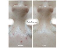 ベルクラージュ(Belle Courage)の雰囲気（REVI 剥離なし・ダウンタイムなしハーブピーリング3回施術★）