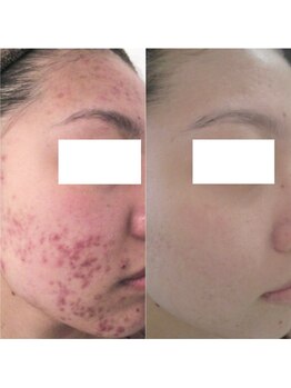 シシィ 二子玉川(sissi)/ニキビケア