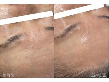 チェリオール(Cherioll)/リブセラプラズマトリートメント