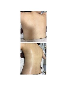 オアジスパ(Oasi Spa)/ブライダル痩身６回