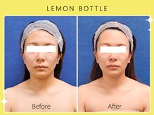 ハノハノ 八代店(HANO HANO)/小顔コルギ×レモンボトル☆